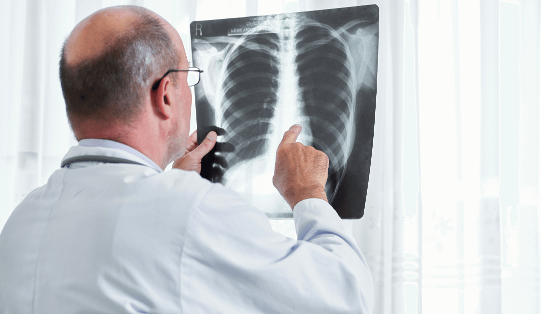 Do Florida Medicare Plans Cover Lung Cancer?