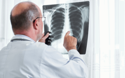 Do Florida Medicare Plans Cover Lung Cancer?
